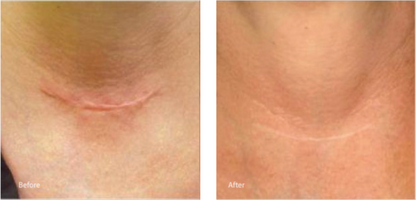 Dermsilk™